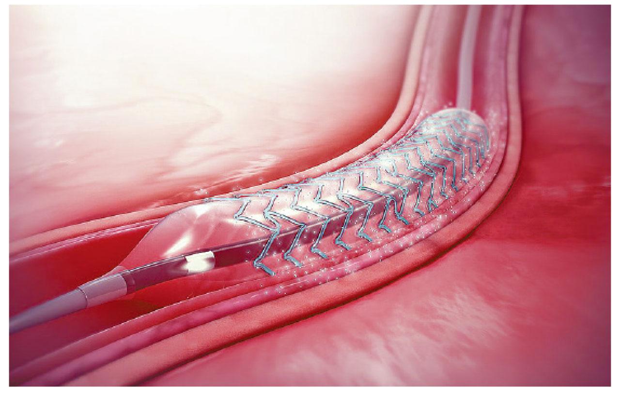 支架不斷演進 通波仔99%成功