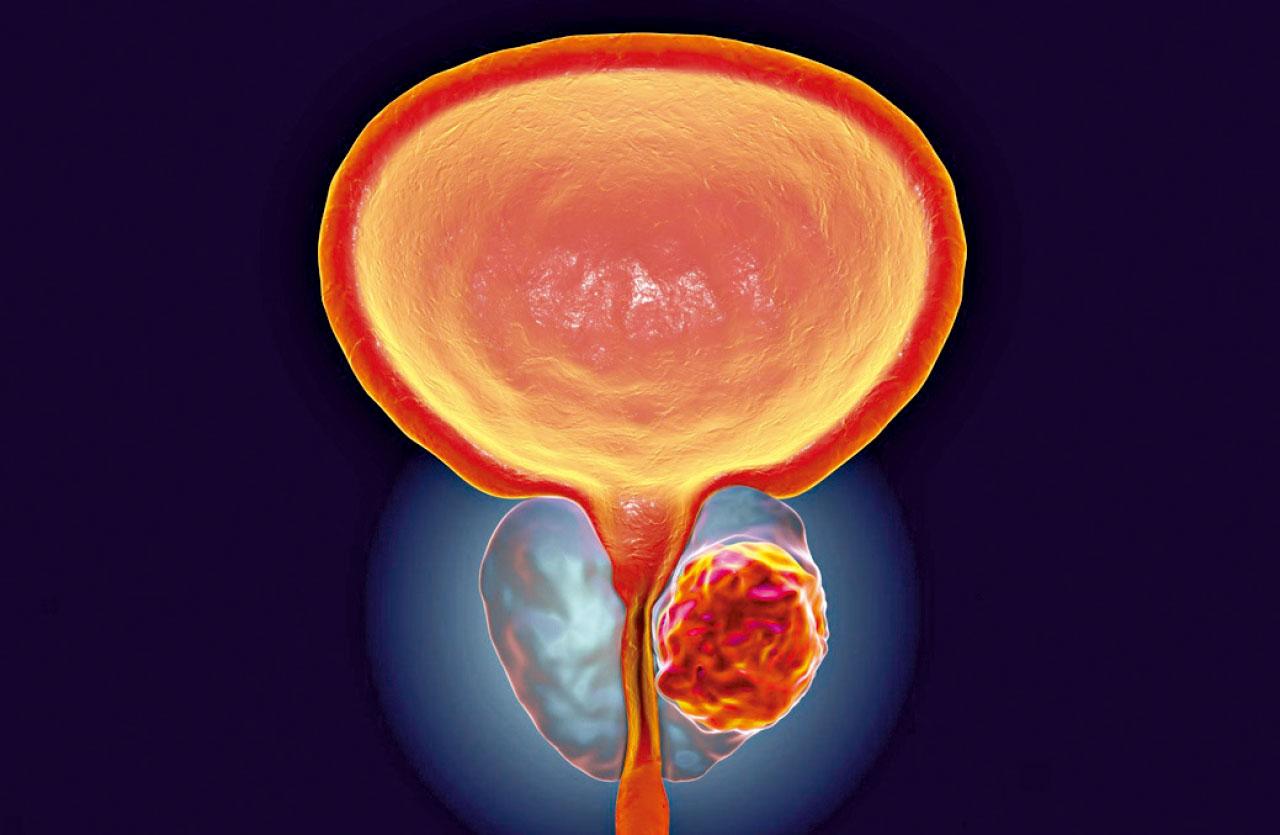 前列腺癌藥費資助減治療負擔