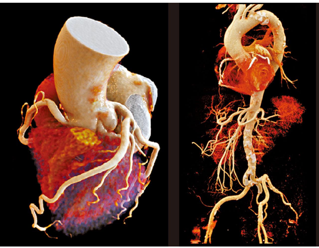 電腦掃描 徹底找出心臟血管問題