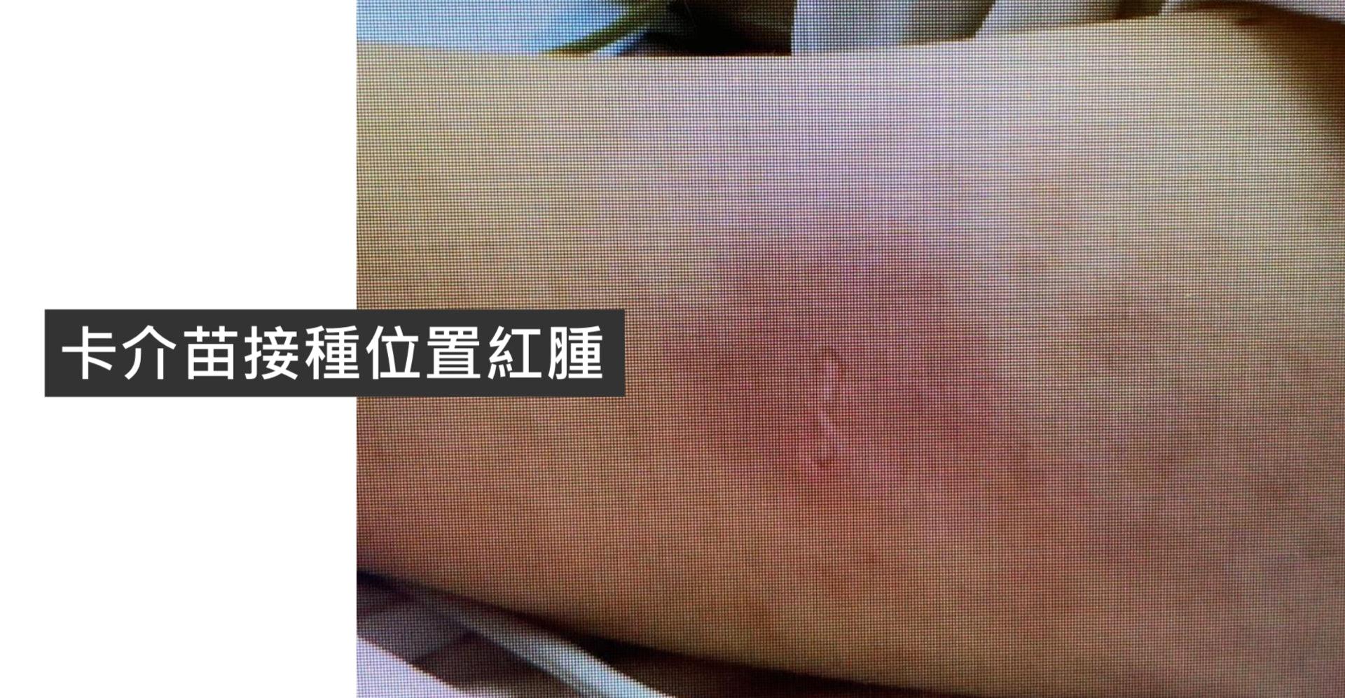 「兒童多系統發炎綜合症」病徵包括卡介苗接種位置紅腫。(醫管局提供)