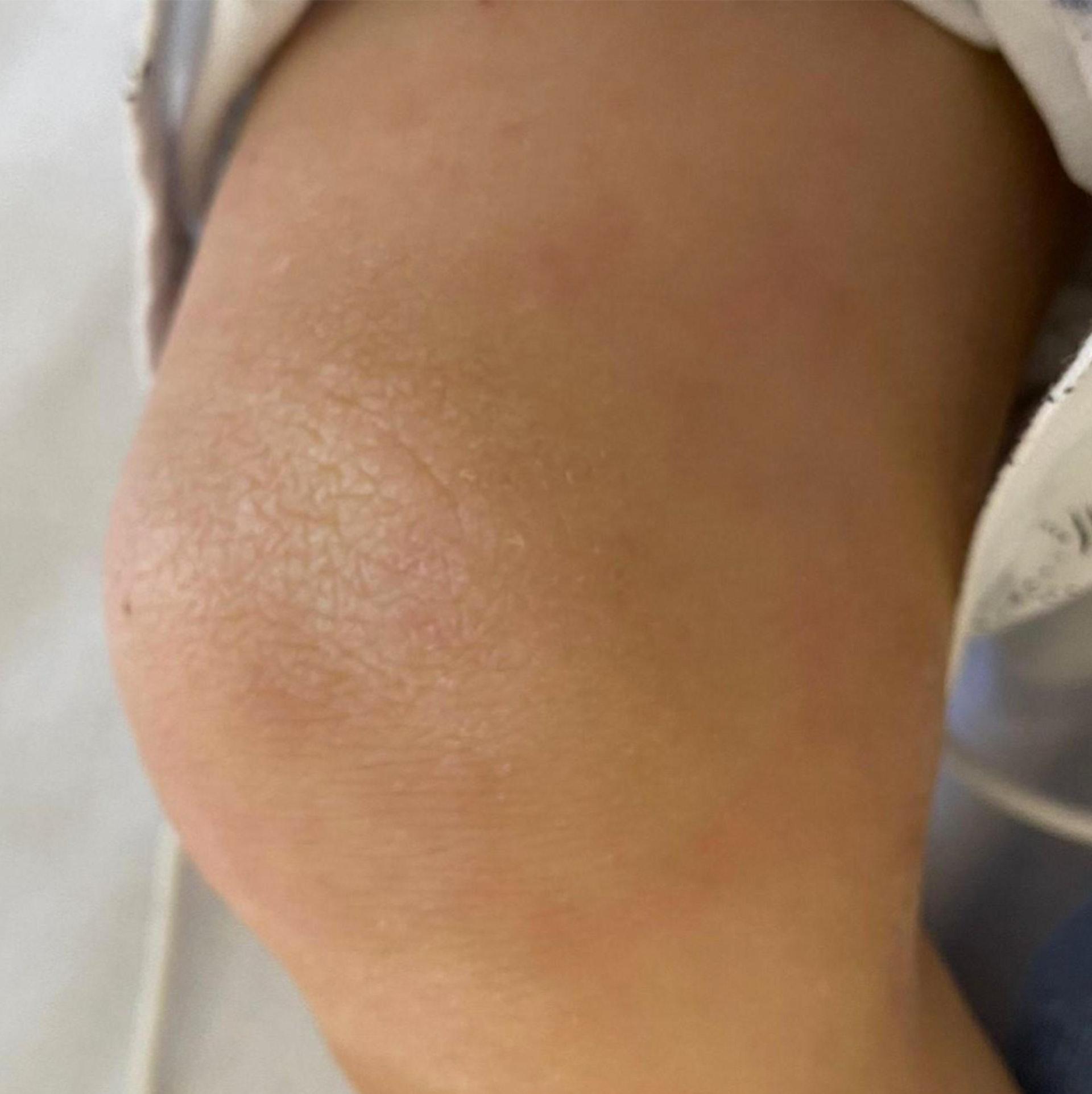 「兒童多系統發炎綜合症」病徵包括皮膚出現紅疹。(醫管局提供)