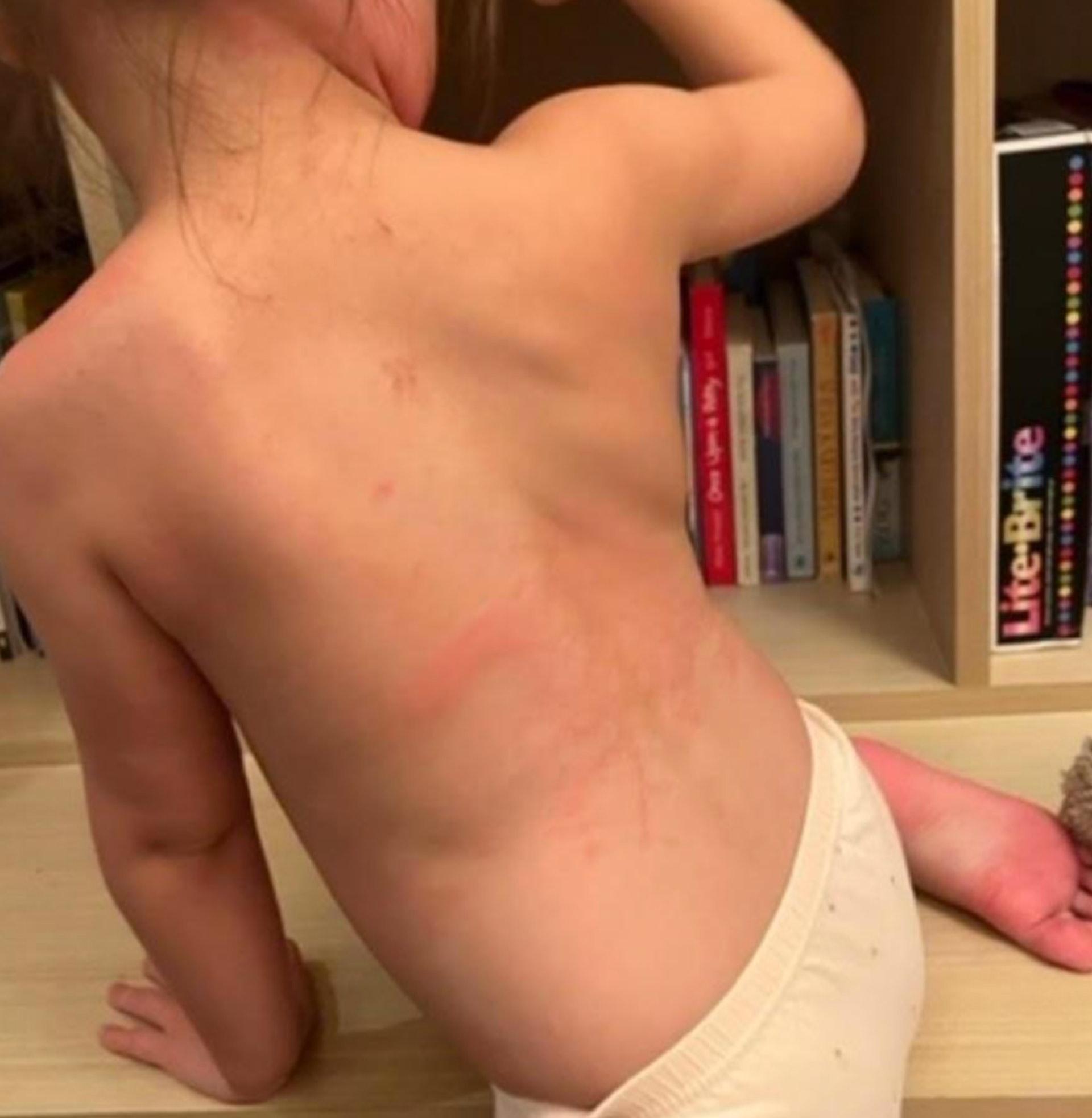 「兒童多系統發炎綜合症」病徵包括皮膚出現紅疹。(醫管局提供)