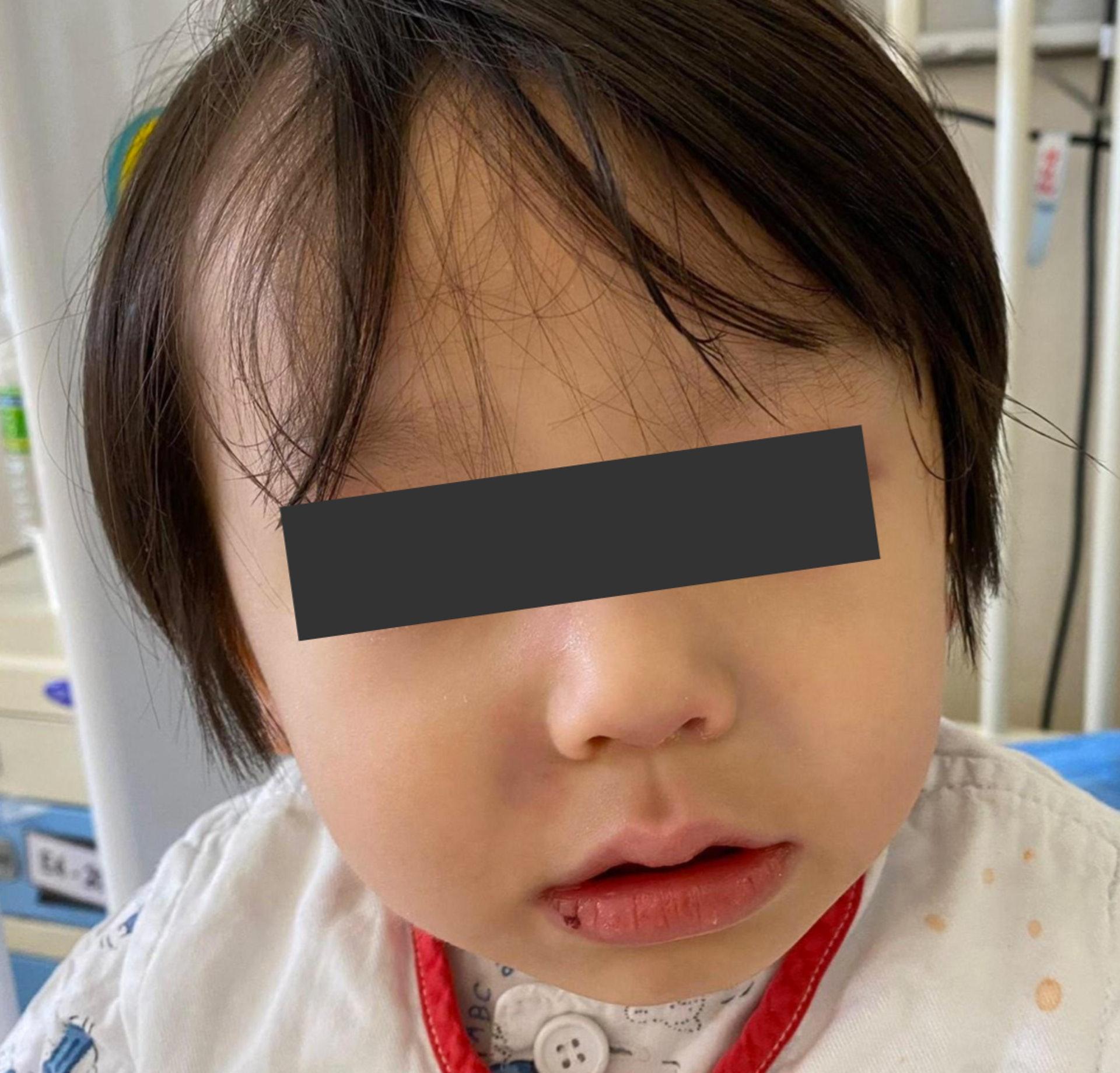 「兒童多系統發炎綜合症」病徵包括嘴角爆裂。(醫管局提供)