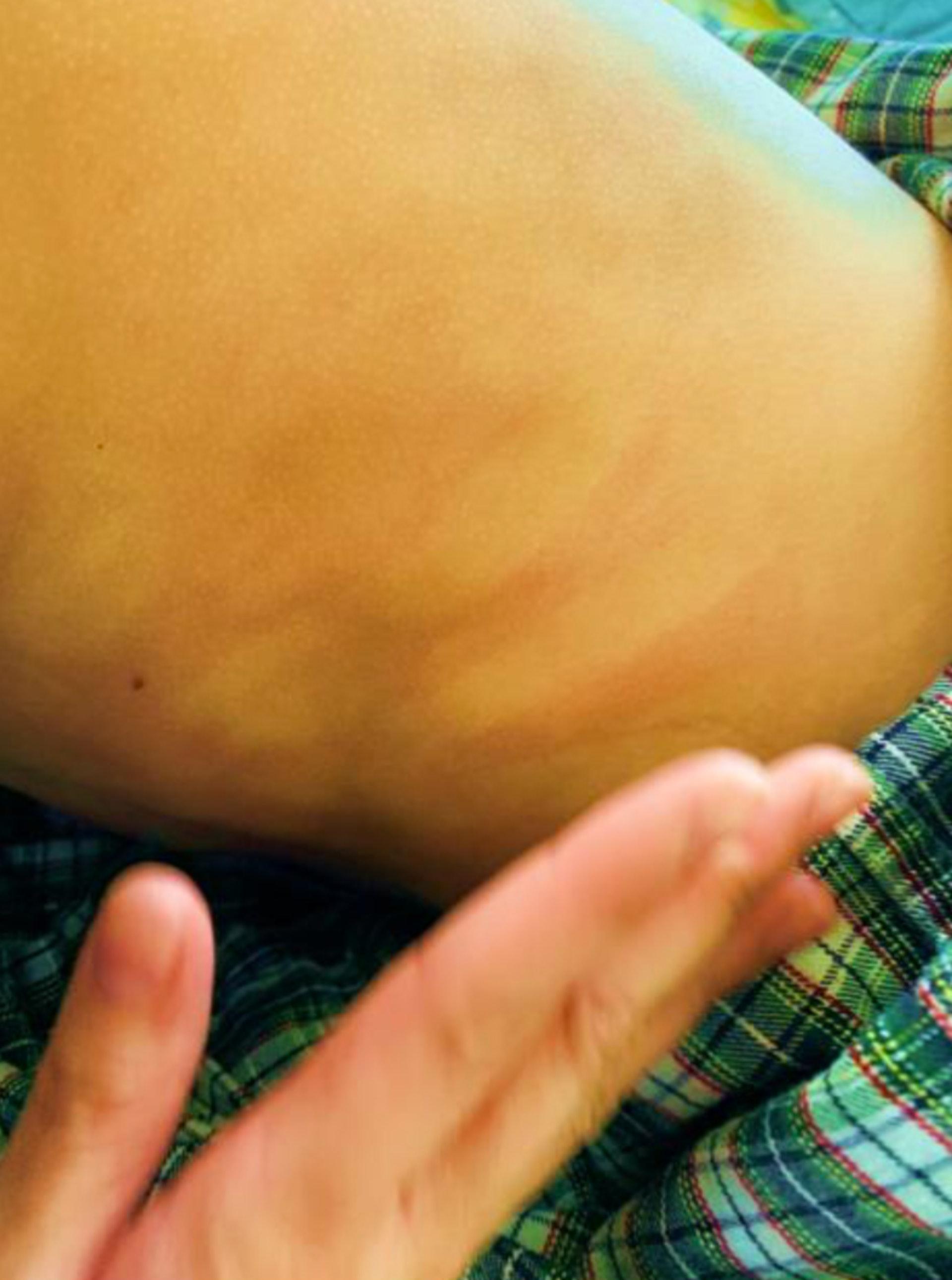 「兒童多系統發炎綜合症」病徵包括皮膚出現紅疹。(醫管局提供)