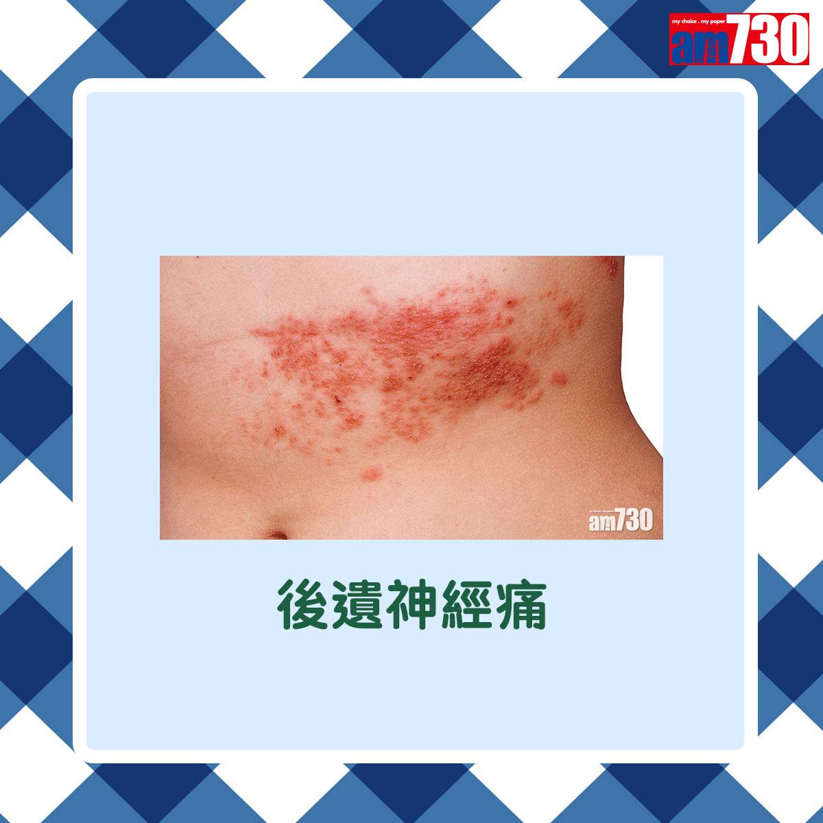 後遺神經痛