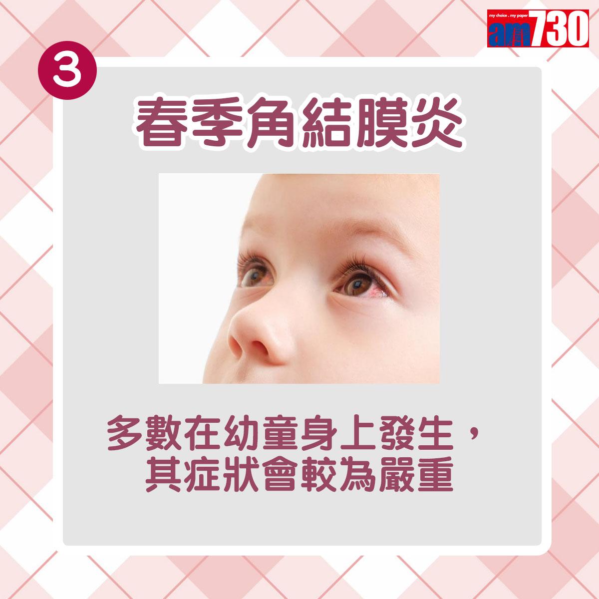 眼晴敏感|最後一種為春季角結膜炎,多數在幼童身上發生,其症狀會較為嚴重
