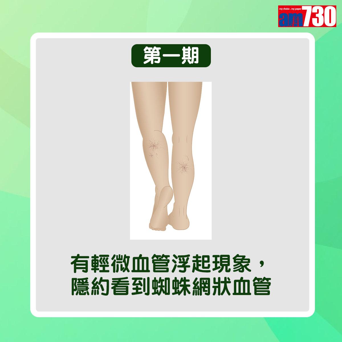 靜脈曲張病情分6個階段(am730製圖)