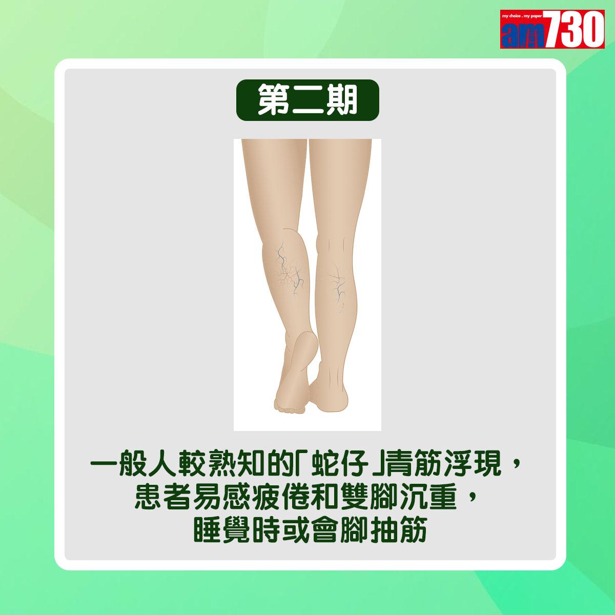 靜脈曲張病情分6個階段(am730製圖)