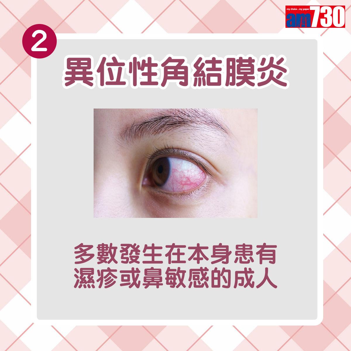 眼晴敏感|第二種為異位性角結膜炎,多數發生在本身患有濕疹或鼻敏感的成人