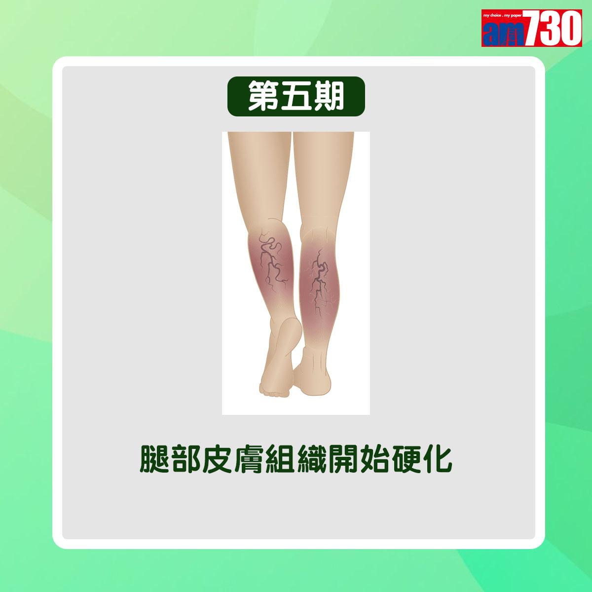 靜脈曲張病情分6個階段(am730製圖)