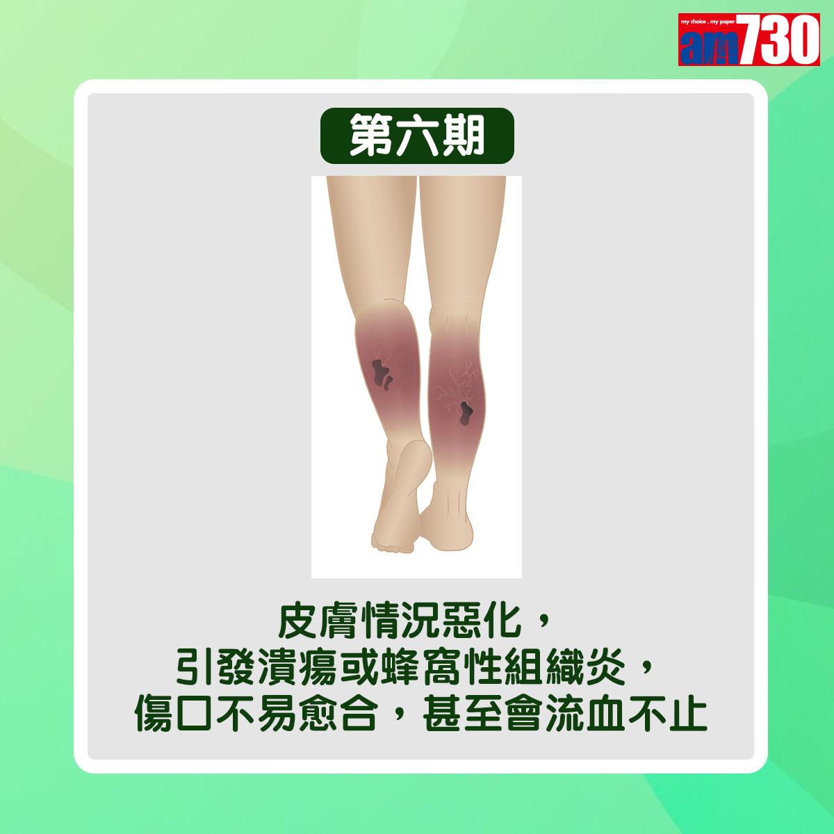 靜脈曲張病情分6個階段(am730製圖)