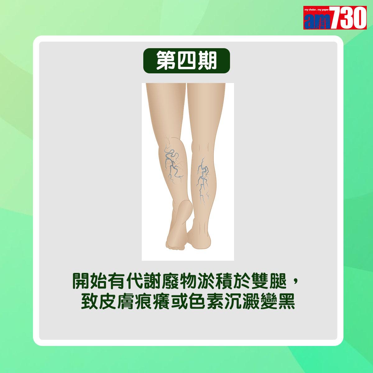 靜脈曲張病情分6個階段(am730製圖)