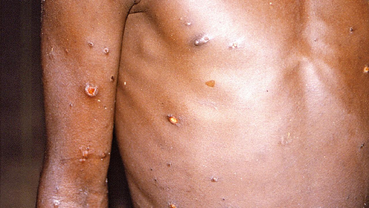 持續爆發|歐美蔓延以色列澳洲 全球現120宗猴痘