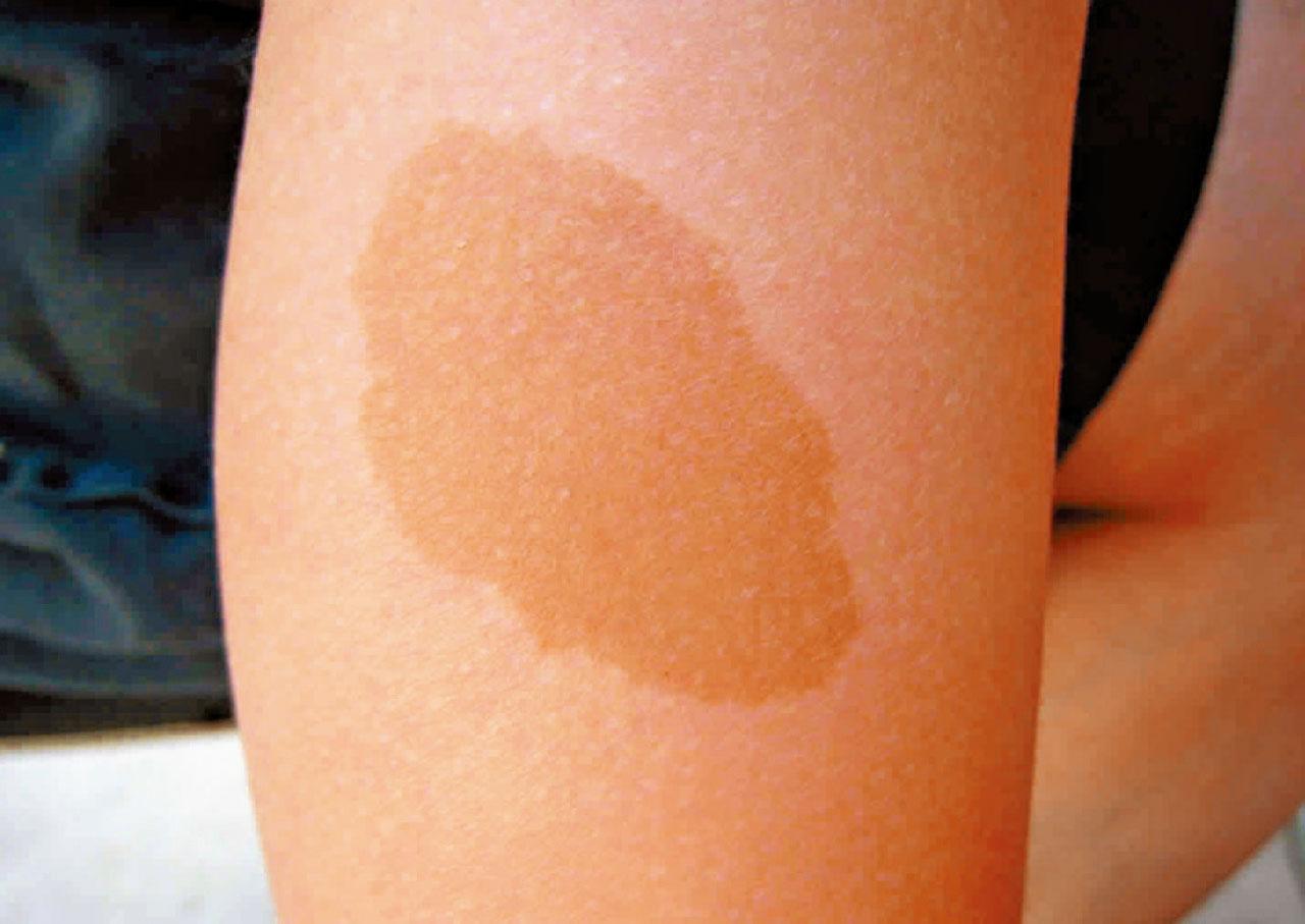 新藥助縮小神經纖維瘤