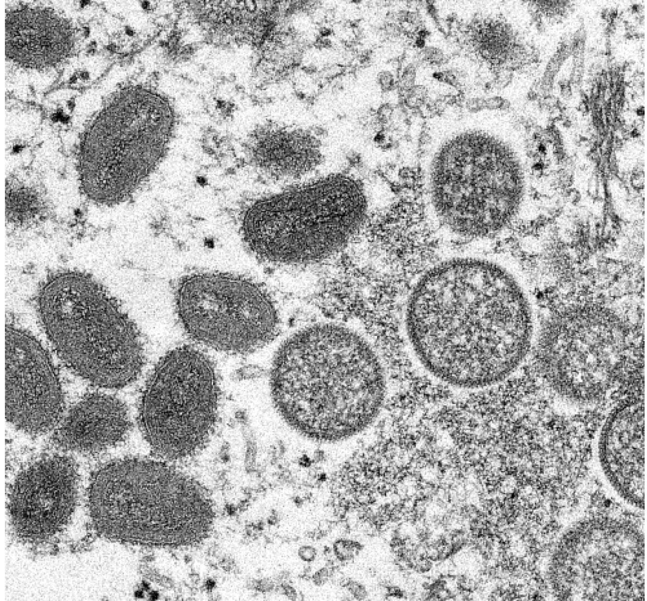 持續爆發|歐美蔓延以色列澳洲 全球現120宗猴痘