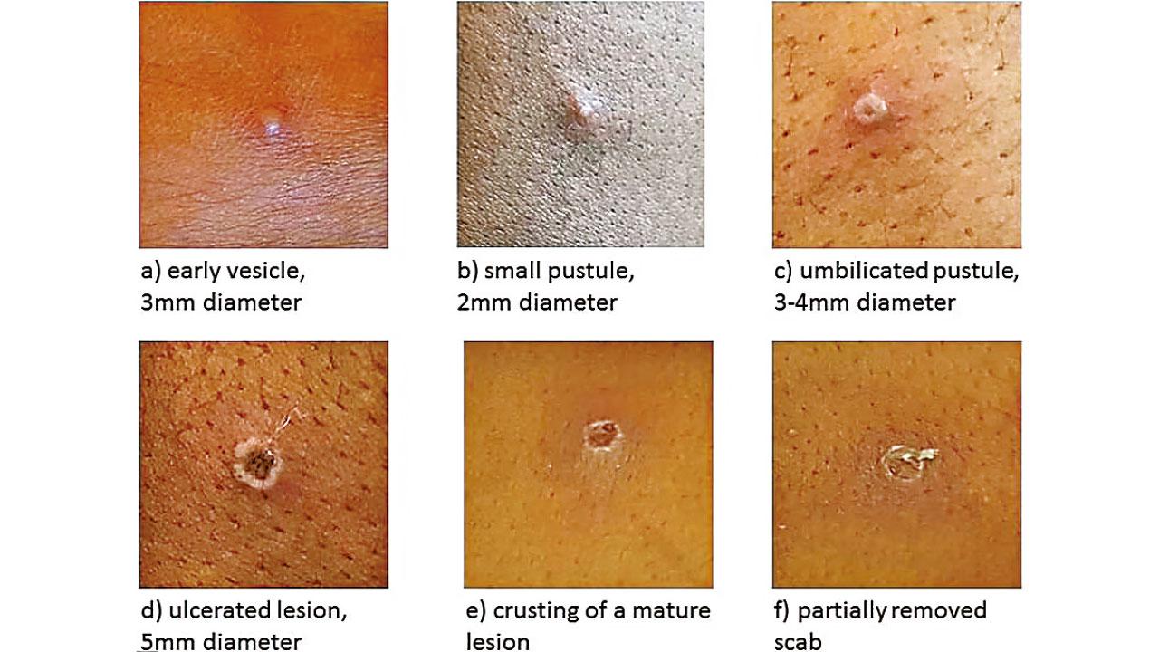 歐洲爆發|捷克斯洛文尼首確診 英國單日增37宗猴痘