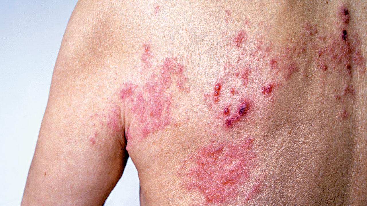 預防生蛇 免後遺症