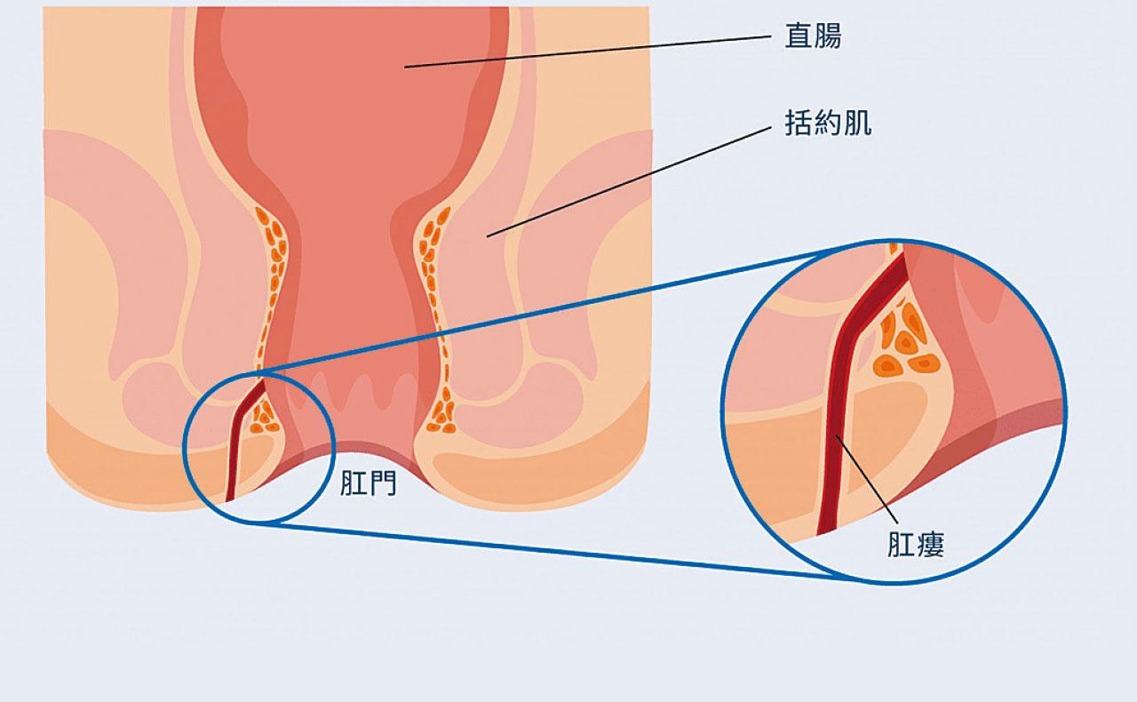 肛門生膿瘡 小心變瘻管