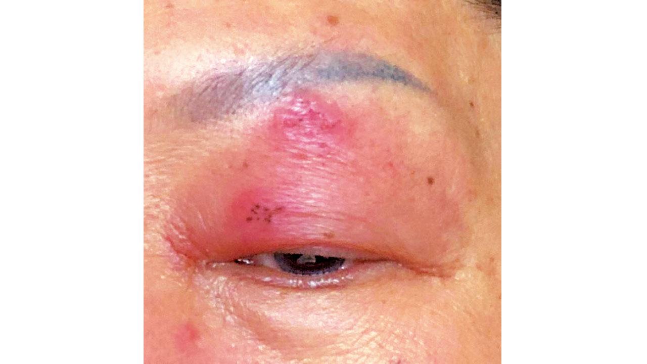 預防生蛇 免後遺症