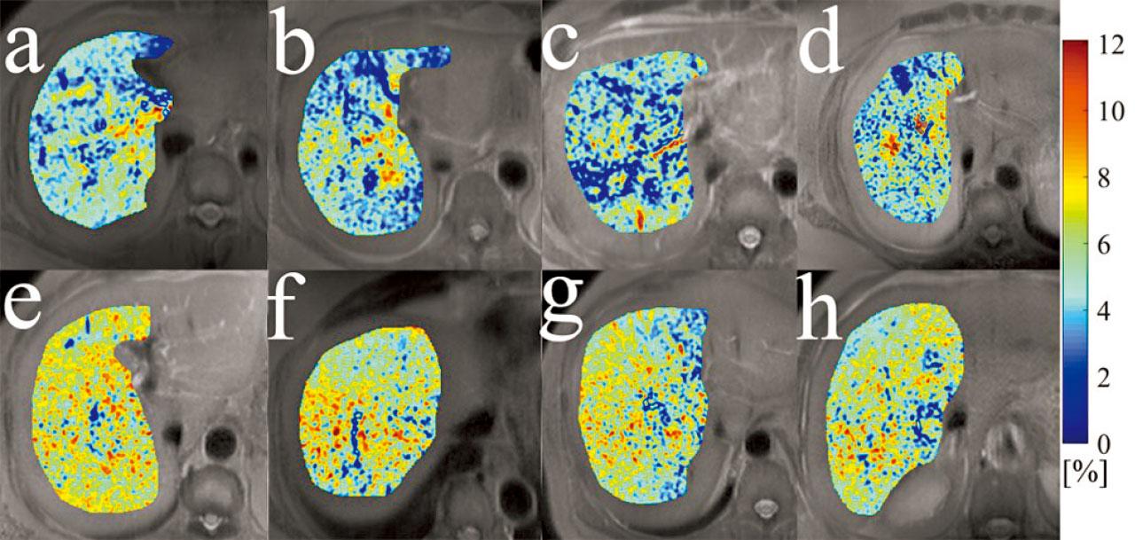 中大新技術檢測早期肝纖維化