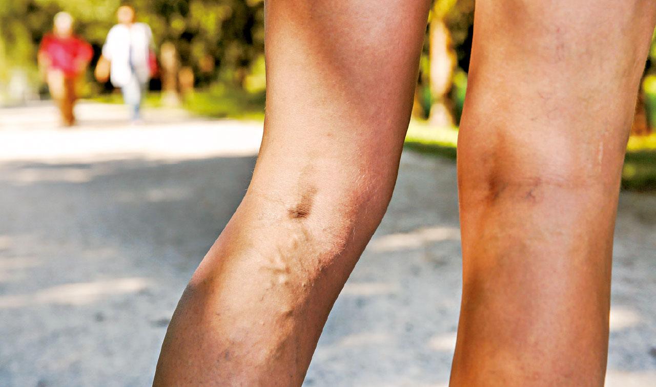 靜脈曲張 隨時皮膚潰爛