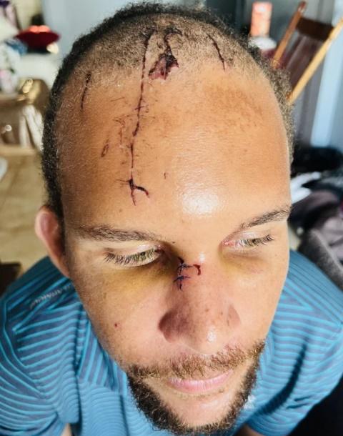 Joshua Young展示傷疤。(網上圖片)