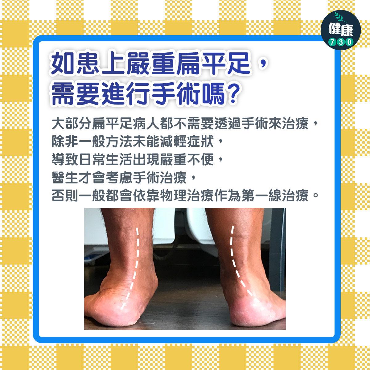 如患上嚴重扁平足,需要進行手術嗎?