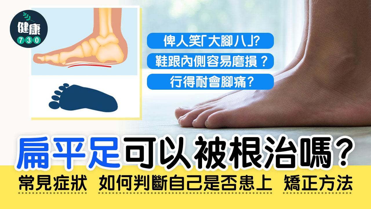扁平足是甚麼?成因及症狀逐一睇 | 物理治療師教你改善方法