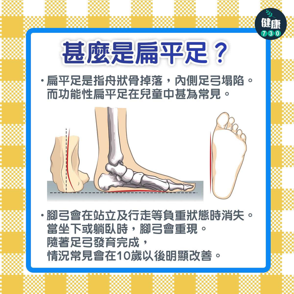 甚麼是扁平足?