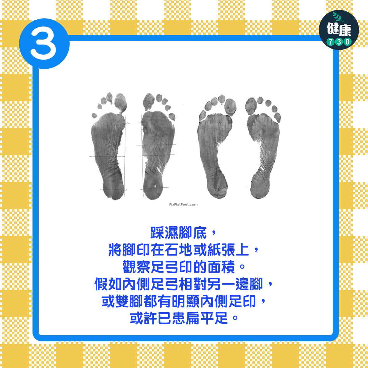 踩濕腳底,將腳印在石地或紙張上,觀察足弓印的面積。假如內側足弓相對另一邊腳,或雙腳都有明顯內側足印,或許已患扁平足。