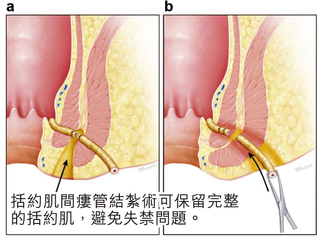肛瘻新手術 避免大便失禁