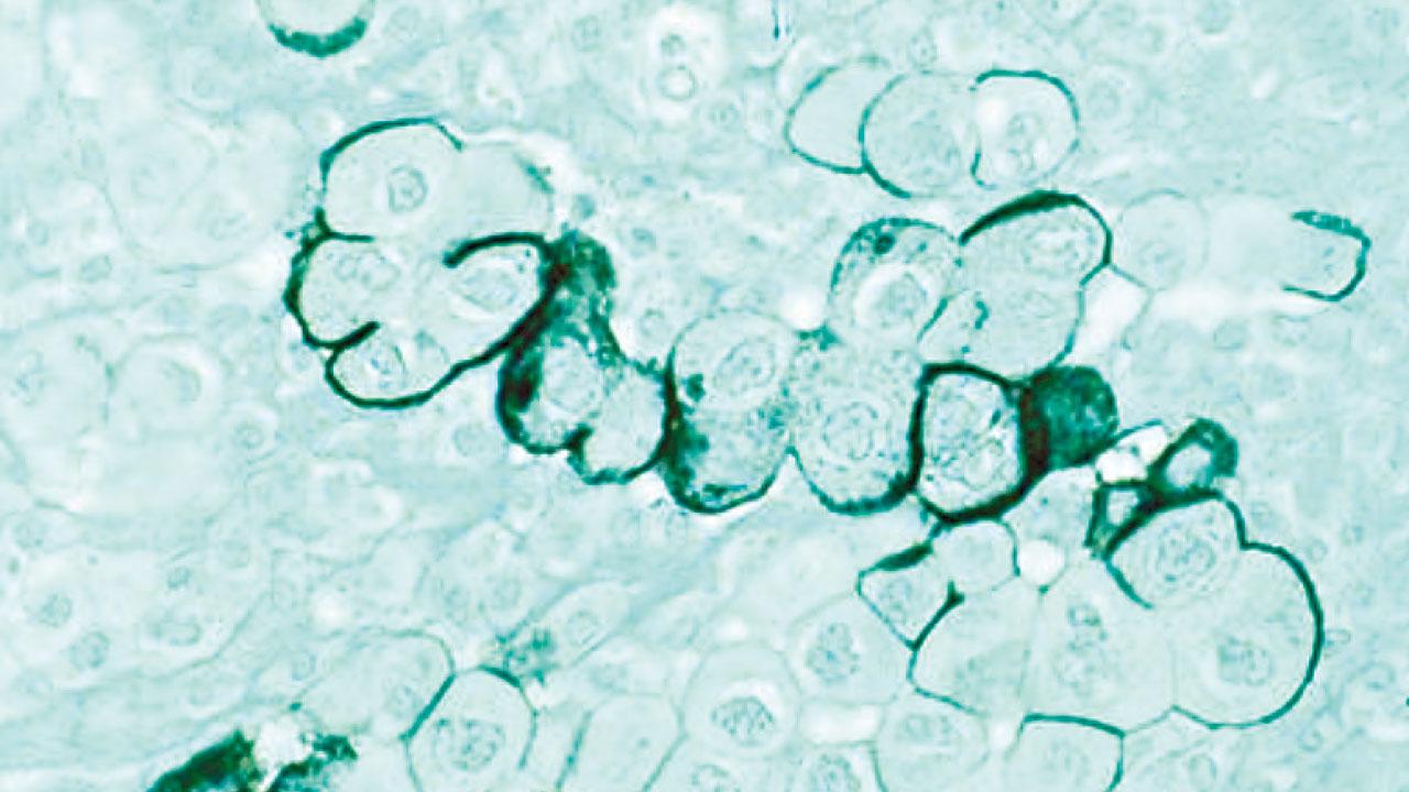 BioNTech研治癌新希望 mRNA疫苗防胰臟癌復發