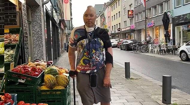 Brenner須靠拐杖步行。(互聯網)