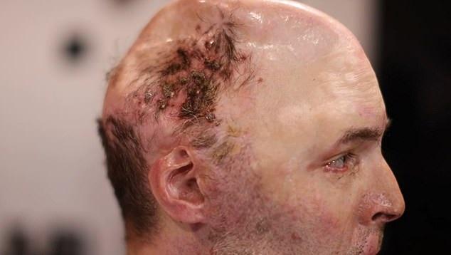 Brenner少了半邊頭骨。(互聯網)