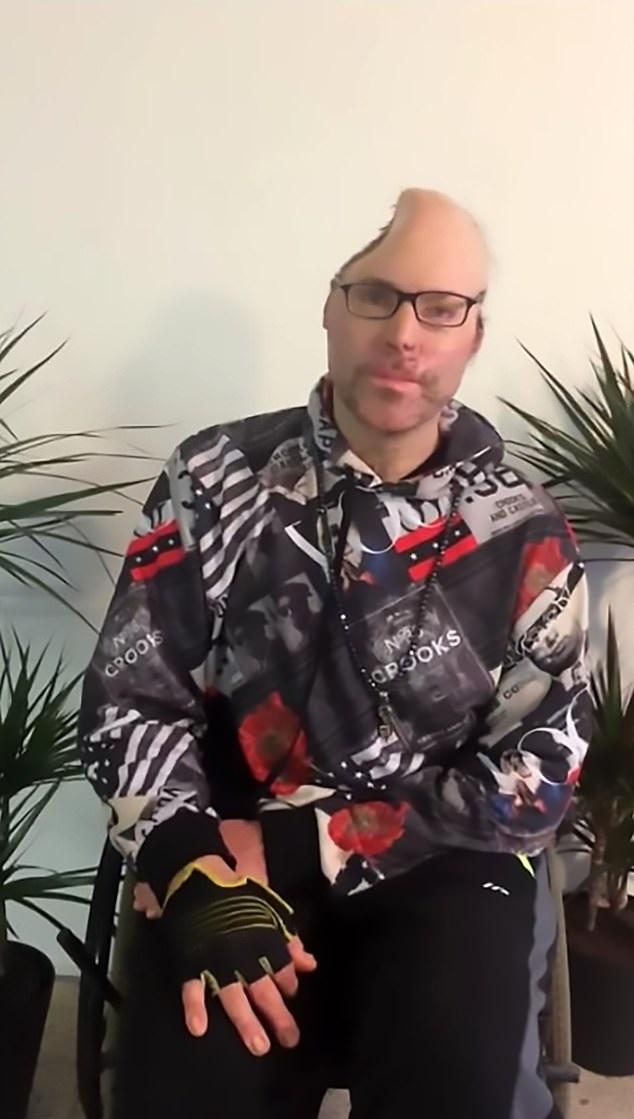 Brenner少了半邊頭骨。(互聯網)