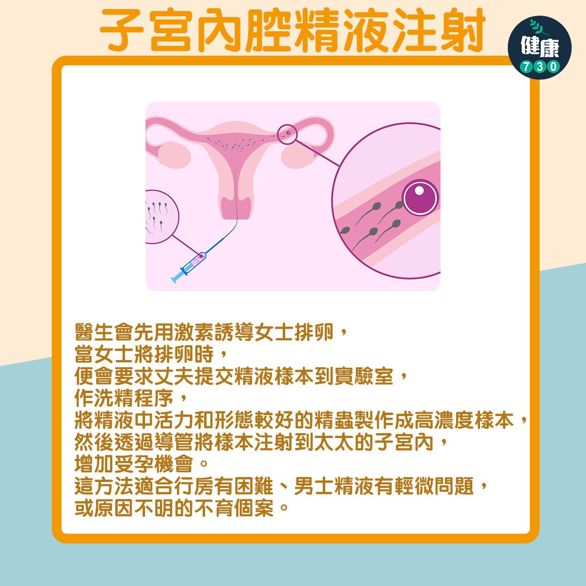 人工受孕方法:子宮內腔精液注射(am730製圖)