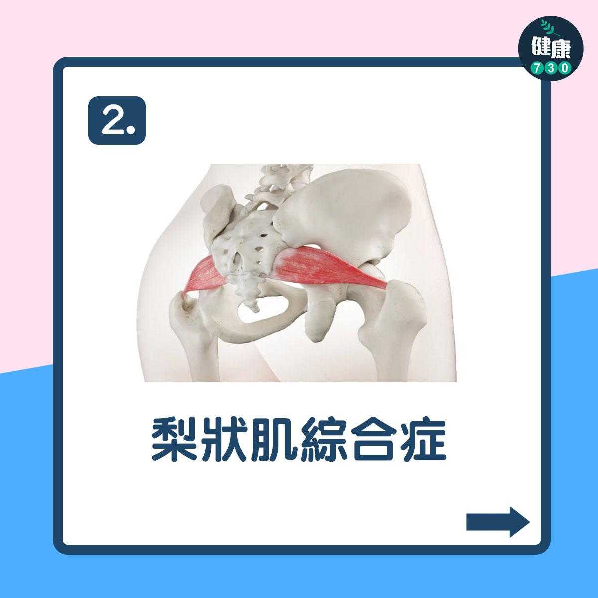 翹腳壞處|有機會導致梨狀肌綜合症(am730製圖)