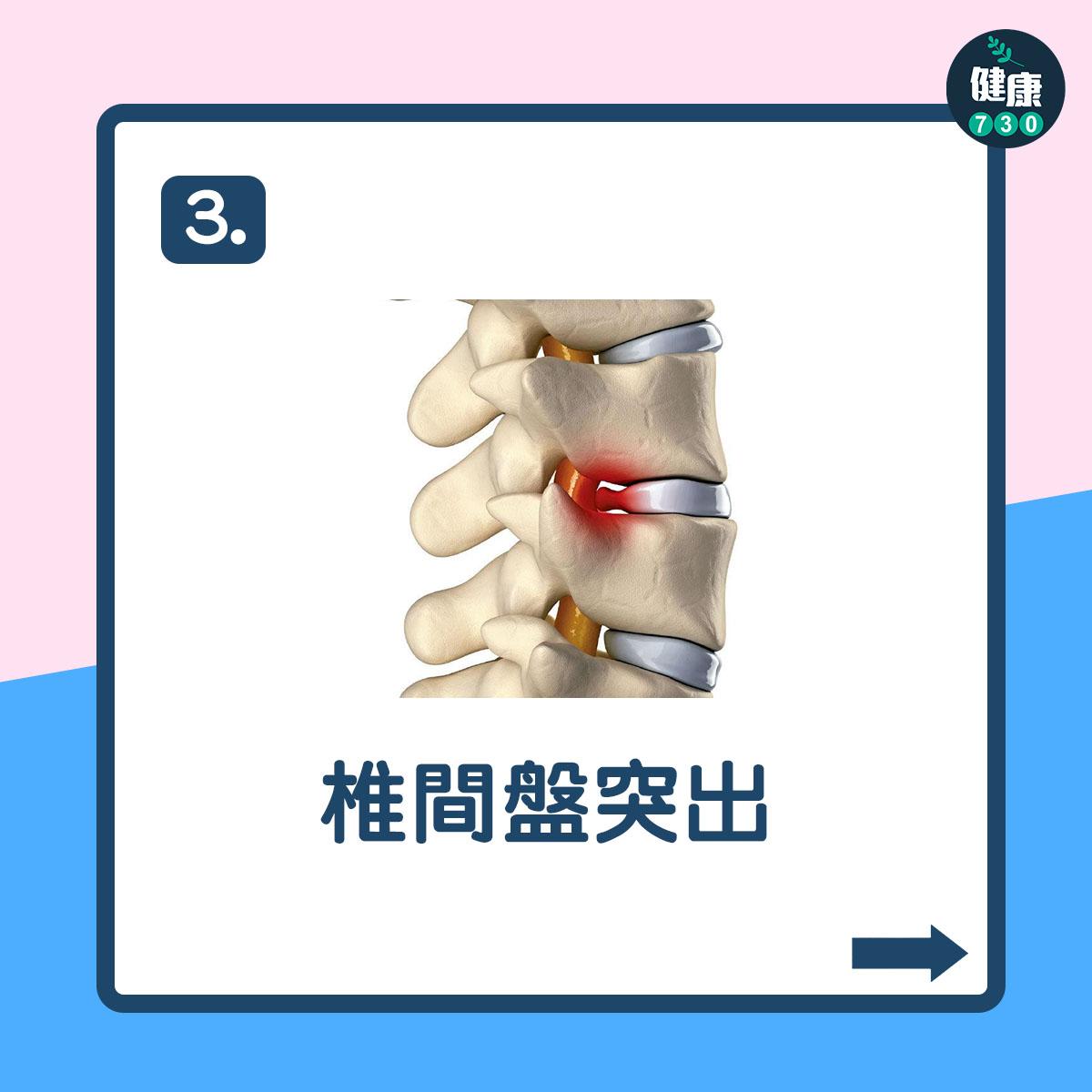 翹腳壞處|有機會導致椎間盤突出(am730製圖)
