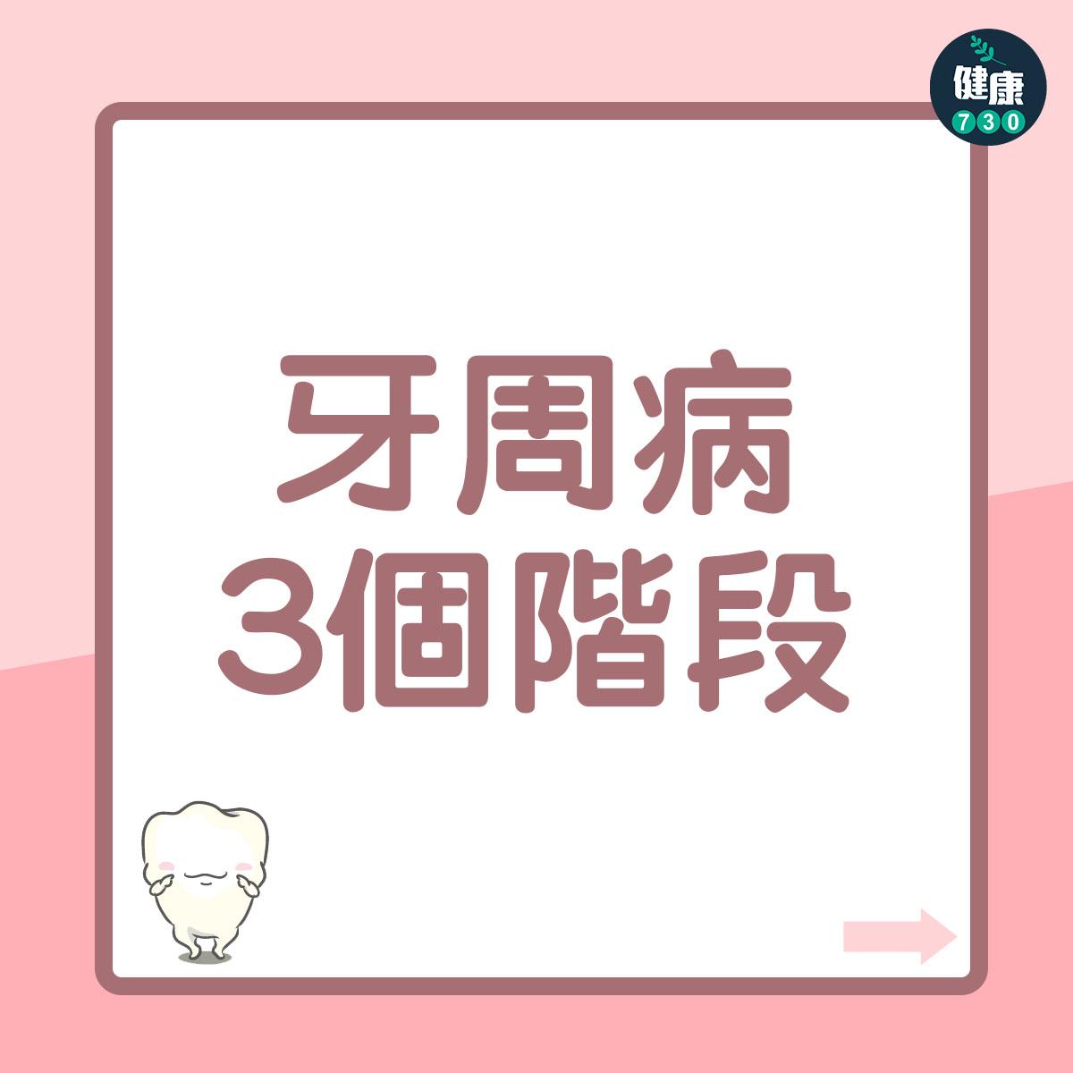 牙周病主要分成3個階段,每一個階段的症狀也有不同︰