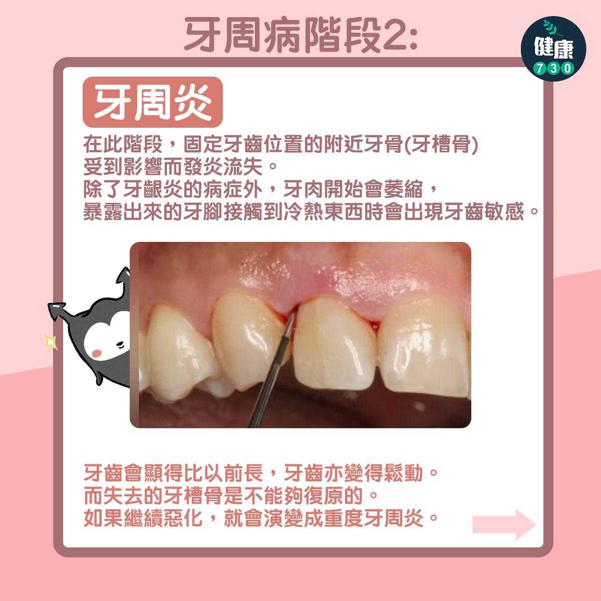 牙周病階段2:牙周炎