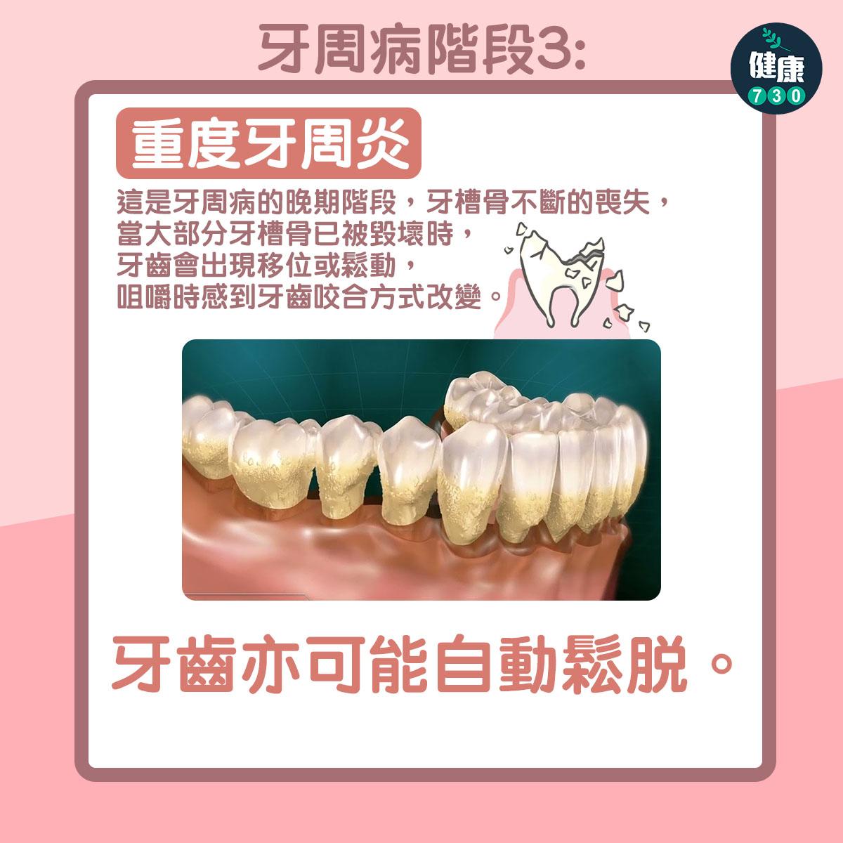 牙周病階段3:重度牙周炎