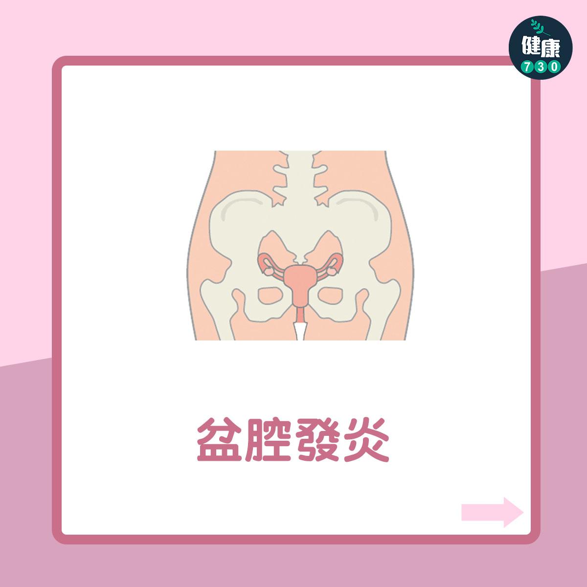 女性不育7大原因(am730製圖)