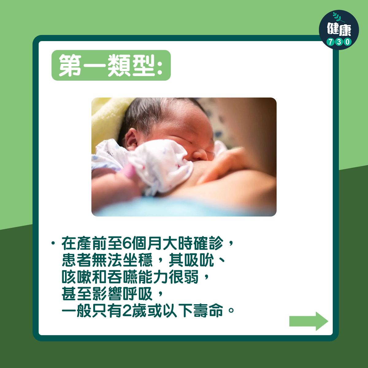 第一類型:在產前至6個月大時確診,患者無法坐穩,其吸吮、咳嗽和吞嚥能力很弱,甚至影響呼吸,一般只有2歲或以下壽命。