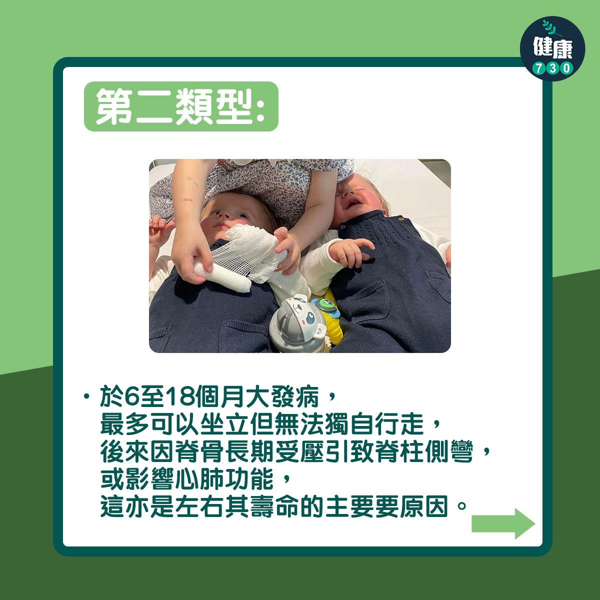 第二類型:於6至18個月大發病,最多可以坐立但無法獨自行走,後來因脊骨長期受壓引致脊柱側彎,或影響心肺功能,這亦是左右其壽命的主要要原因。