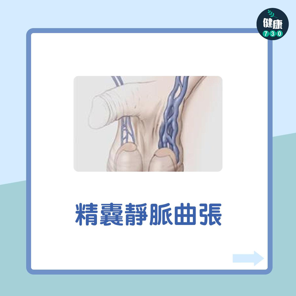 男性不育7大原因︰精囊靜脈曲張(am730製圖)