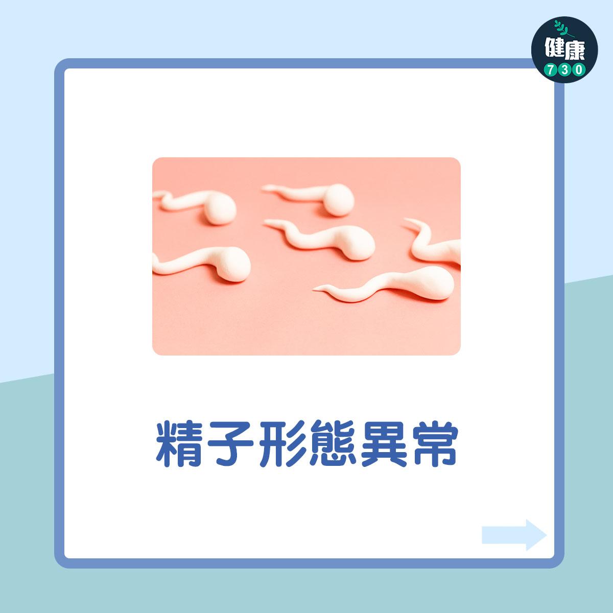 男性不育7大原因︰精子形態異常(am730製圖)