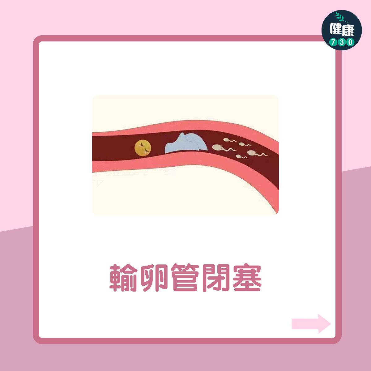 女性不育7大原因(am730製圖)