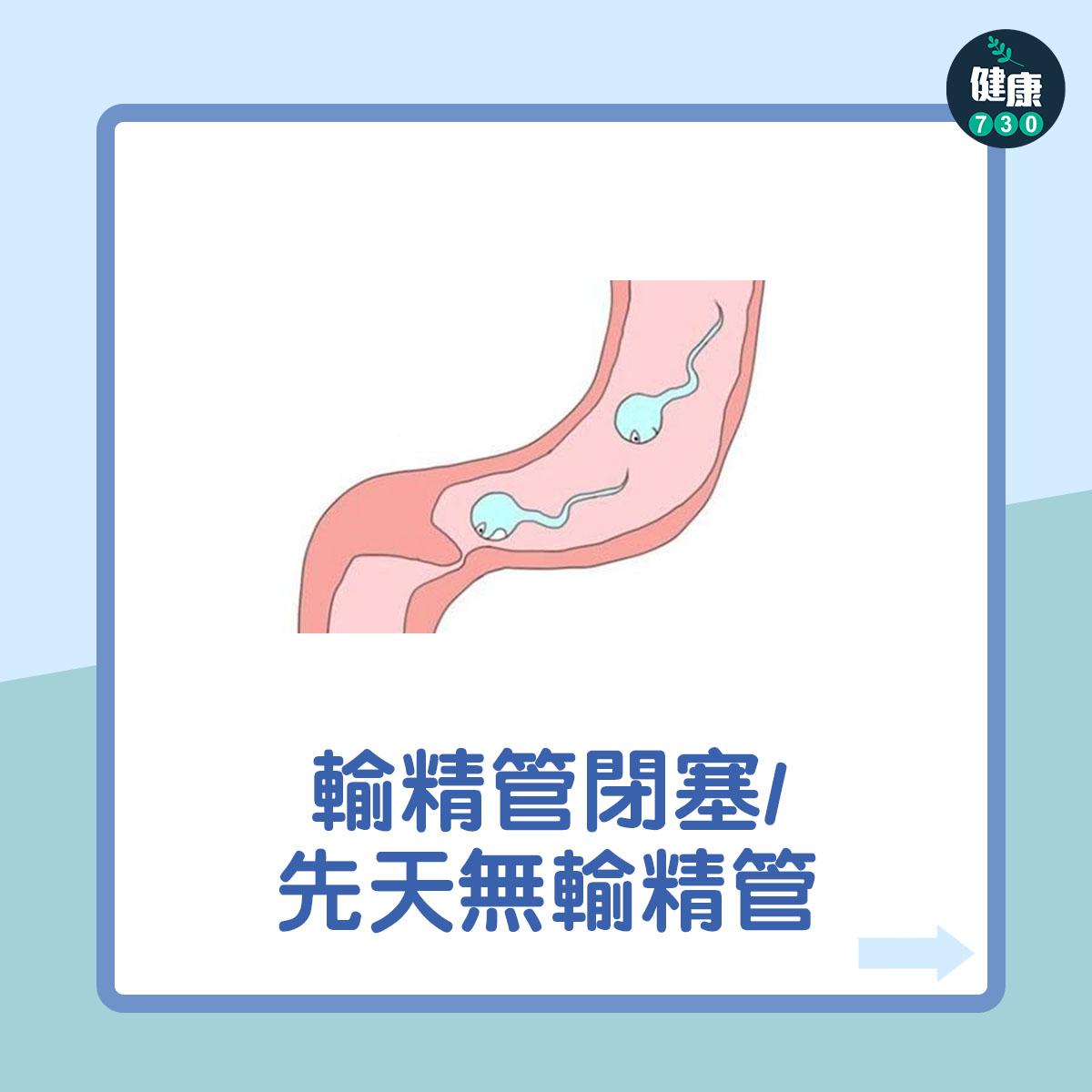 男性不育7大原因︰輸精管閉塞 先天無輸精管(am730製圖)