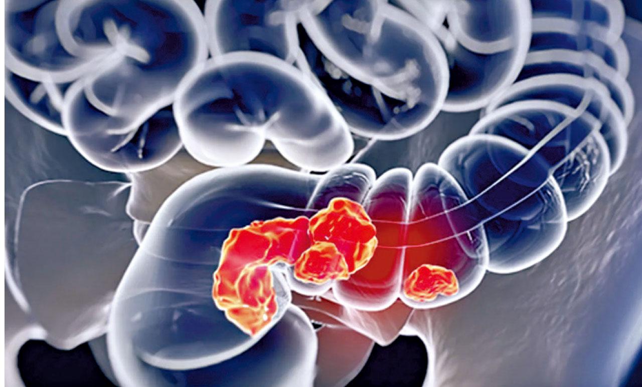 研究證實西化飲食易患大腸癌