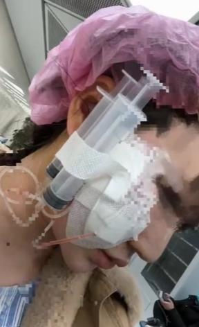 陳女士聽信「一針降顴骨」,讓一名美容博主打美容針, 結果細菌感染毀容,多次治療亦未好轉。(互聯網)